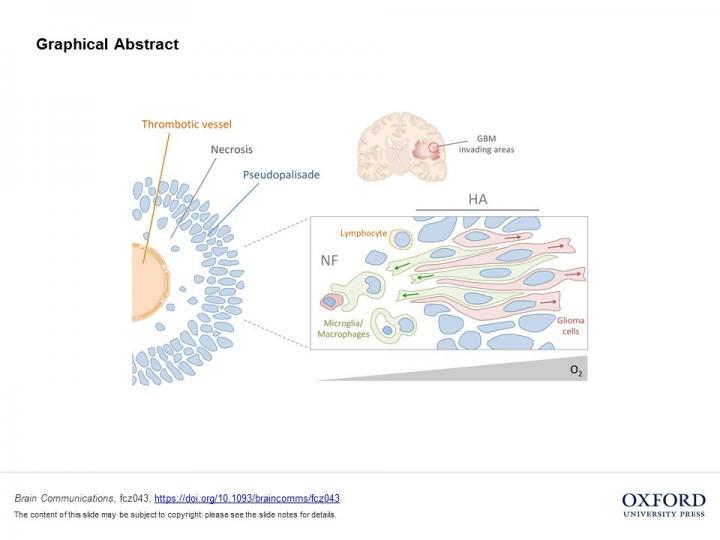 Immune System Cells Contribute to the Invading Capacity of Brain Tumours