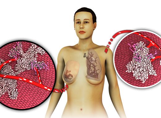 Breast Cancer Metastasis