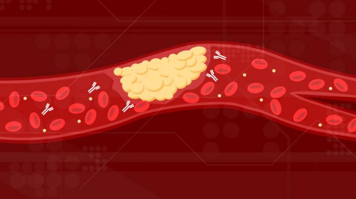 New Cause of COVID-19 Blood Clots Identified