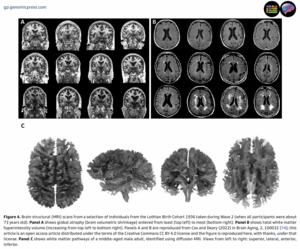 Brain structural (MRI) scans from a selection of individuals from the Lothian Birth Cohort 1936 taken during Wave 2 (when all participants were about 73 years old)