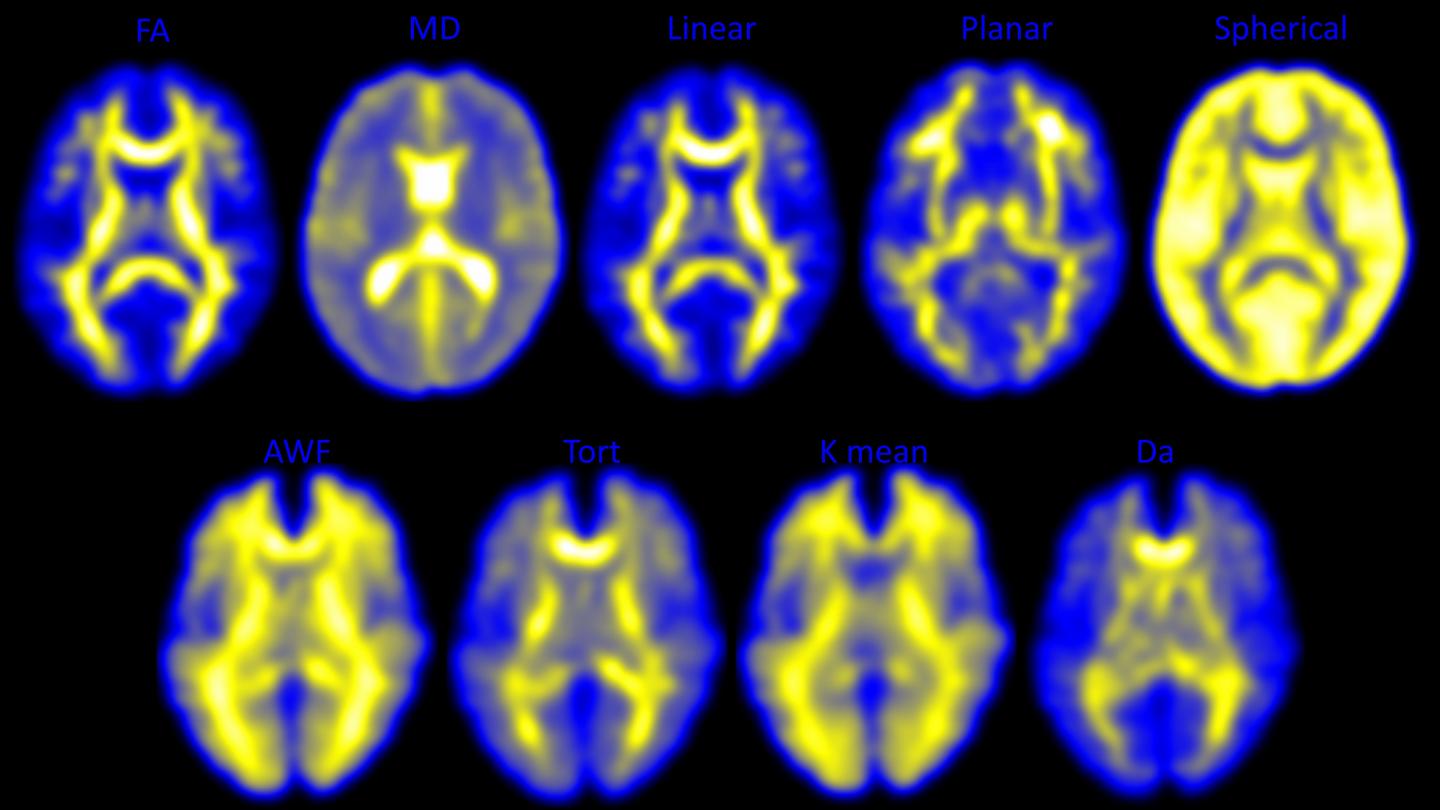 Diffusion Tensor Imaging
