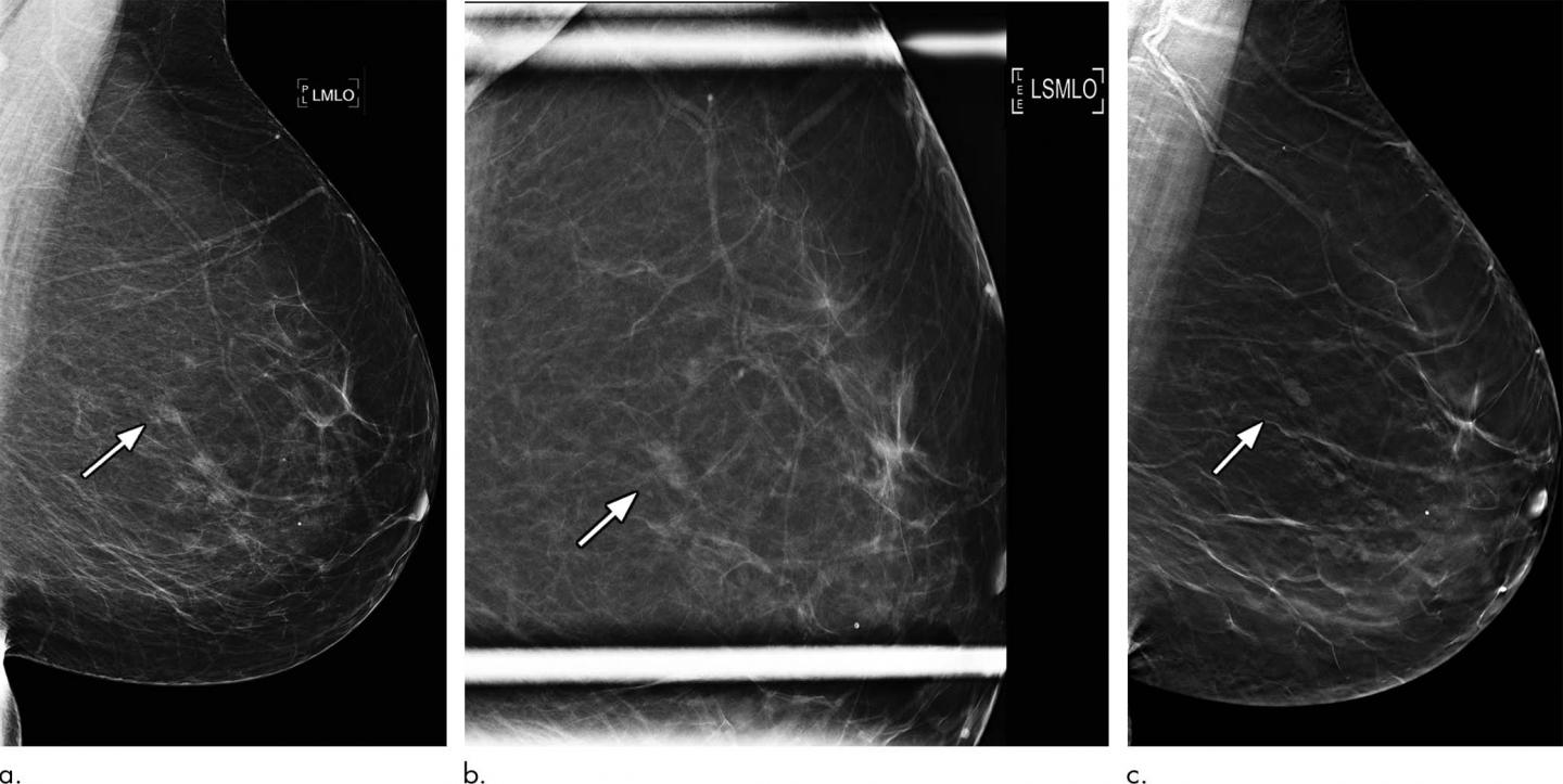 3d Mammography Significantly R [image] Eurekalert Science News Releases