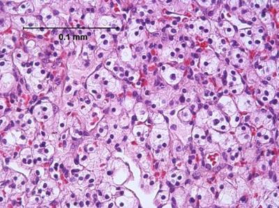 High Magnification Micrograph of a Clear Cell Renal Cell Carcinoma, H and E Stain