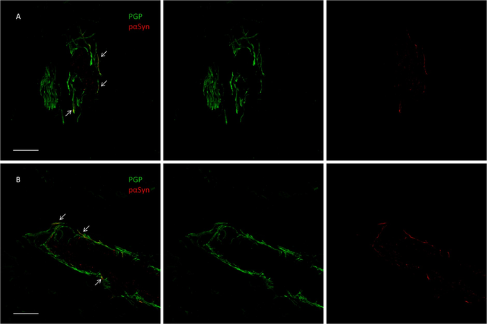 Confocal microscope study of p-syn deposits in a dermal arteriole of a patient with PD