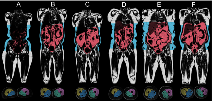 Image of visceral and subcutaneous fat around organs