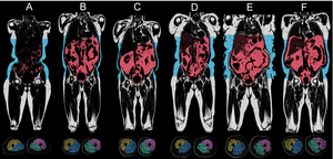 Image of visceral and subcutaneous fat around organs