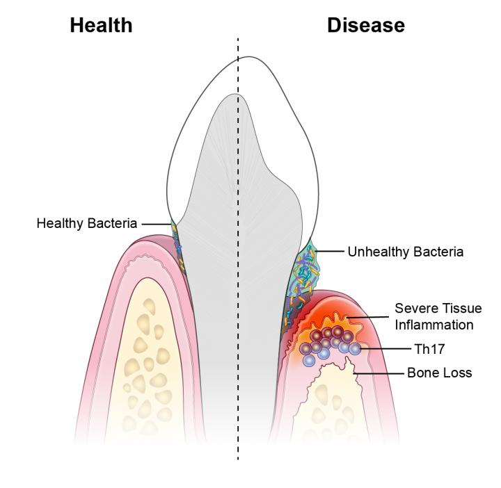 Illustration of Tooth and Gums in Presence of Healthy and Unhealthy Bacteria