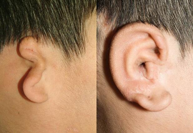 Before and after Ear Reconstruction
