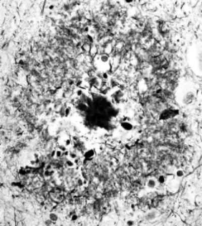 Amyloid in the Brain