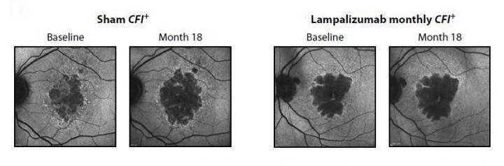 Seeing Promise in a New Treatment for Age-Related Macular Degeneration (1 of 1)