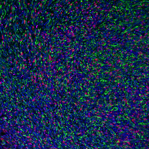 Tumor with FMRP-deficient cancer cells (in green) being infiltrated and attached by killer (CD8) T cells.