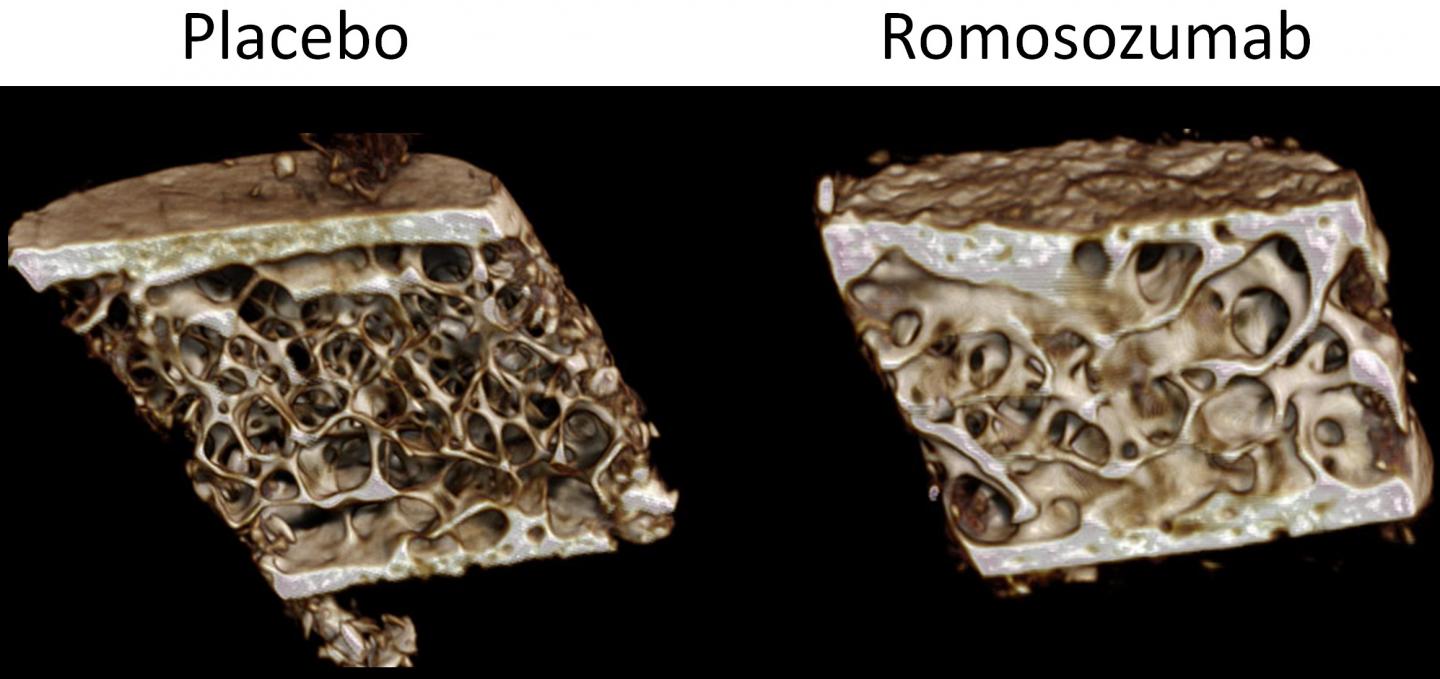 New Osteoporosis Therapy's Dual Effects on Bone Tissue