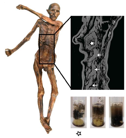 The Iceman's Gastrointestinal Tract