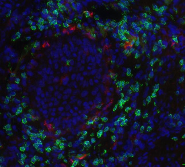 Researchers Reveal Cause of Aggressive Skin Cancer in Patients with Butterfly Syndrome