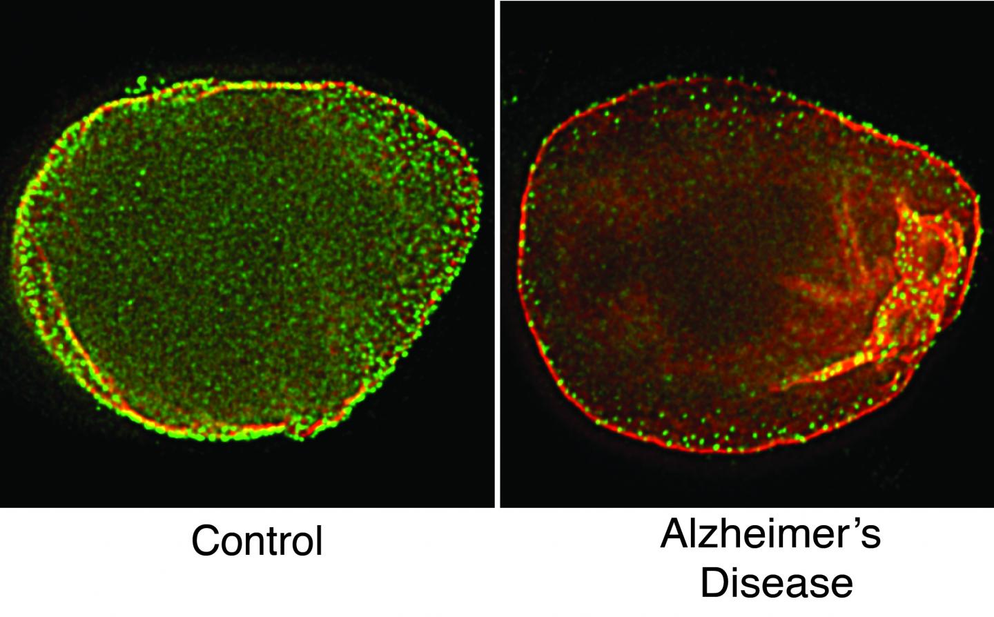 Brain Cell Dysfunction in Alzheimer's Disease