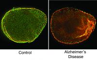 Brain Cell Dysfunction in Alzheimer's Disease