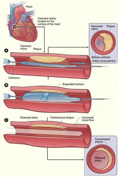 Cross-Section of a Coronary Artery