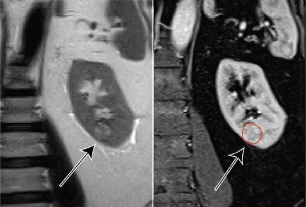 a. 64-Year-Old Man With Clear Cell Likelihood Score (ccLS) 5 Renal Masses