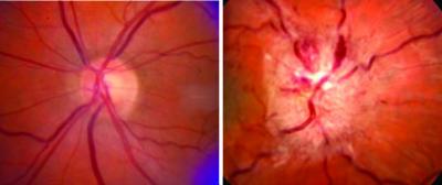 Optic Nerve Swelling in IIH
