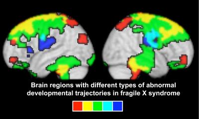 Fragile X Difference of a Difference Map
