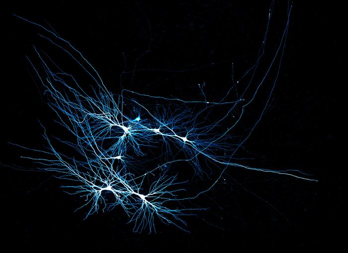 Human CA3 pyramidal neurons in patient tissue sample