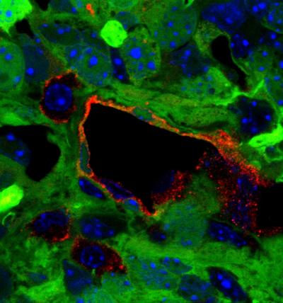 Conversion of Brain Tumor Cells into Blood Vessels Thwarts Treatment Efforts