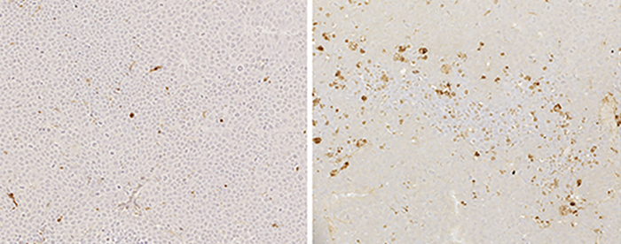 A decoy receptor causes multiple myeloma cell death