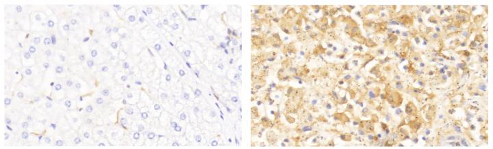 IL-18 Is Elevated in Fulminant Viral Hepatitis