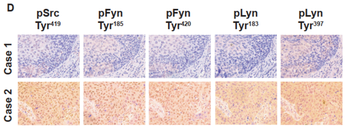 Src/Fyn/Lyn axis positively correlates with the progression of ESCC