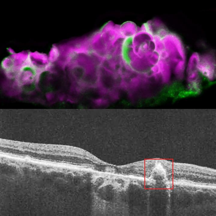 Amelotin and HAP in Dry AMD