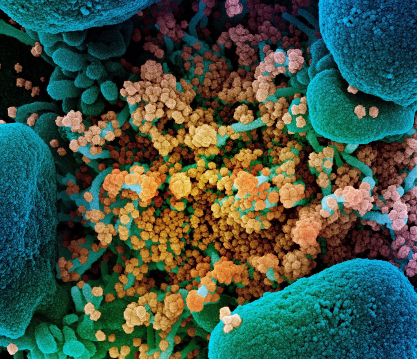 Scanning electron micrograph of a cell infected with SARS-CoV-2