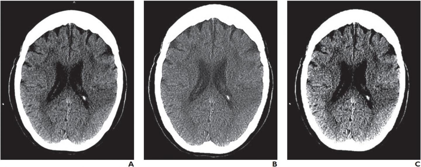 Appearance of Same Unenhanced CT Scan on Three Reading Systems