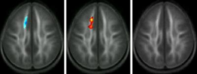 Differences in White Matter