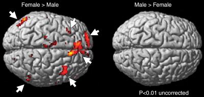Sex Differences of Working Memory Functional Activation