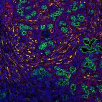 Surrounding Cells Provide Signals to Pancreatic Tumors
