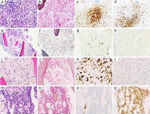 Acute myeloid leukemia was established after multiple bone marrow biopsies in a child with cytopenia and bone marrow fibrosis