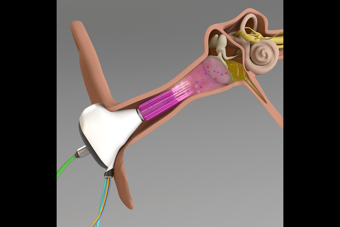 Treating the Middle Ear