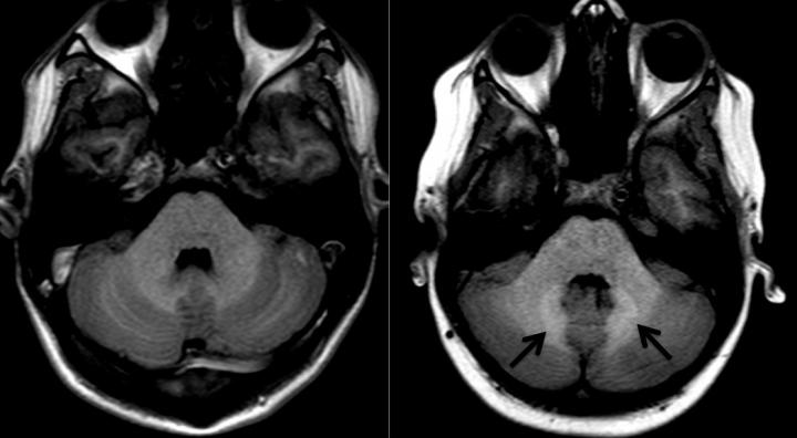 MRI Brain Images
