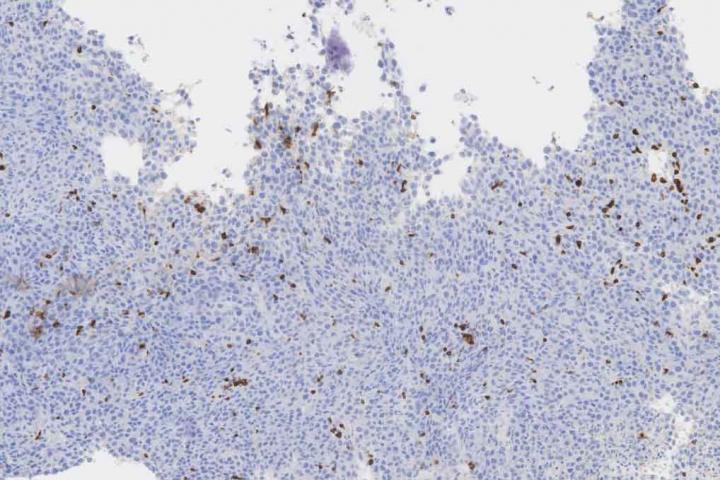 Immunohistochemistry Staining of T Cell Populations in Colorectal Tumor Tissue
