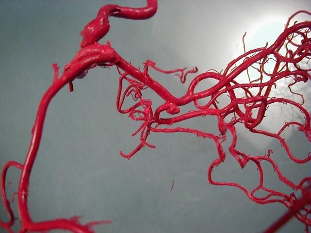 Human Brain Vessels with Aneurysm