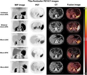 New PET/CT technique accurately diagnoses adr | EurekAlert!