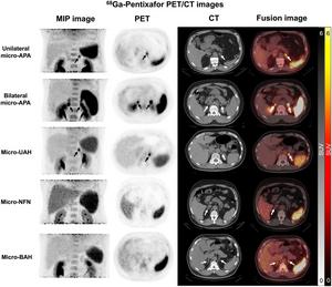 Performance of 68Ga-pentixafor PET/CT in PA patients with different adrenal micronodules.