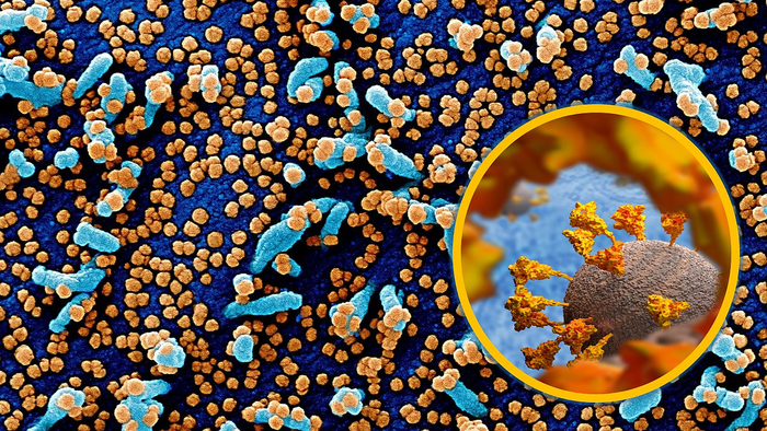 Colorized scanning electron micrograph of cells heavily infected with COVID-19 virus particles