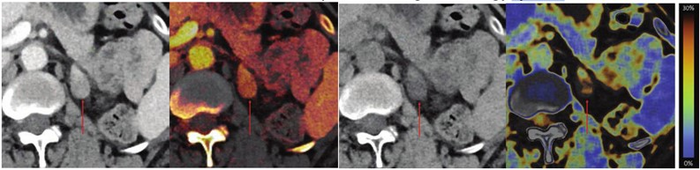 58-year-old patient with right lower quadrant pain, who underwent abdominopelvic CT using dual-energy system