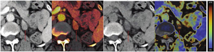 58-year-old patient with right lower quadrant pain, who underwent abdominopelvic CT using dual-energy system