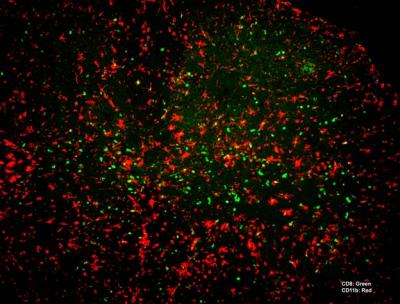 Virus-fighting cells attacking brain cells