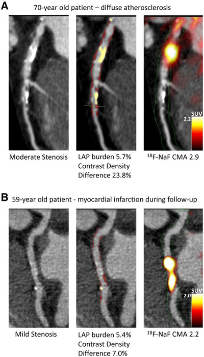 Case examples of quantitative plaque analysis on coronary CT angiography and 18F-NaF PET in patients with established coronary artery disease.