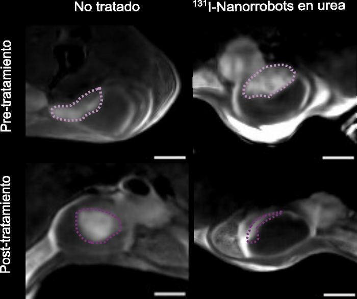 4_Reducción tamaño tumor post-tratamiento