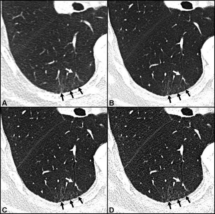 Photon-Counting CT Shows More Post-COVID-19 Lung Damage