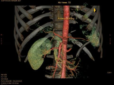 Diagnosis Value of Multi-Slice Spiral CT in Renal Trauma